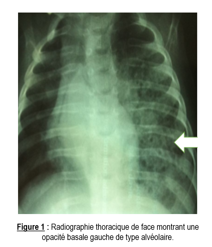 hemoptysie