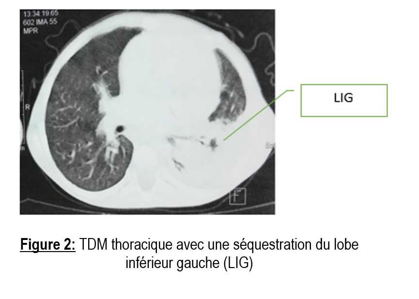 hemoptysie1