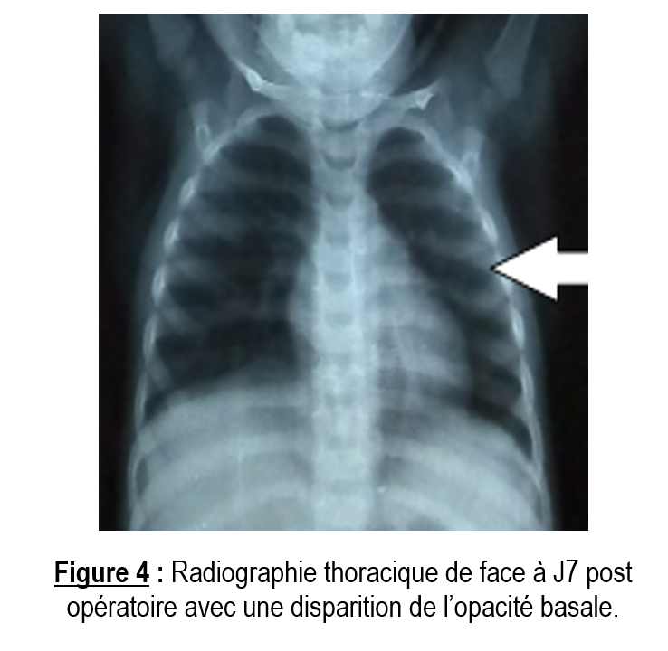 hemoptysie2