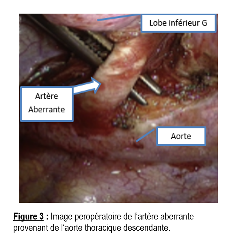 hemoptysie3